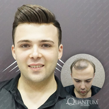 protez saç öncesi ve sonrası