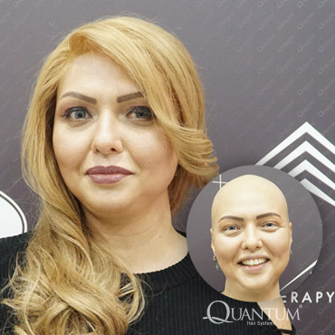 protez saç öncesi ve sonrası