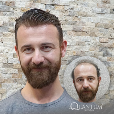 protez saç öncesi ve sonrası